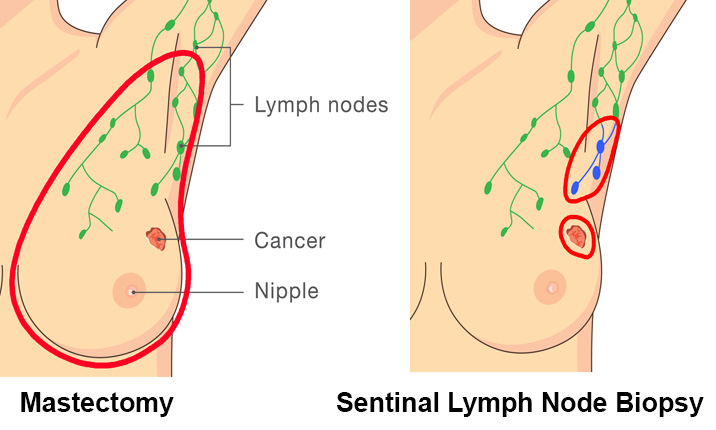 breast cancer treatment sentinel lymph node biopsy